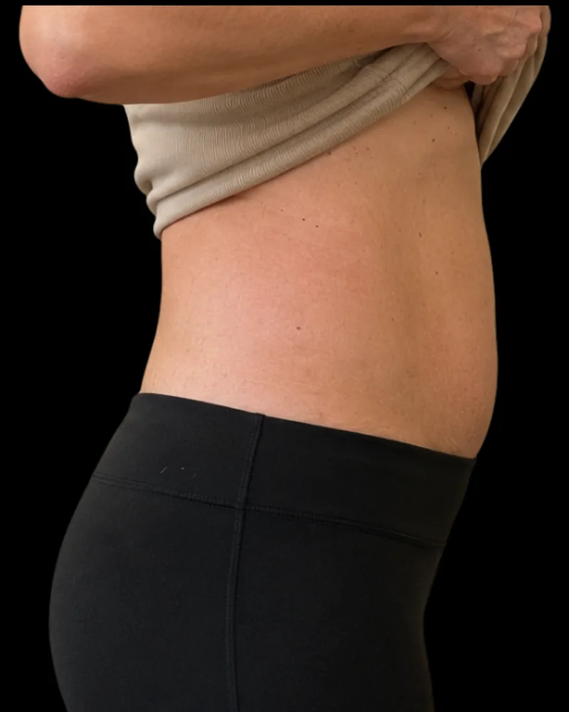 After the BAQ Method, abdomen