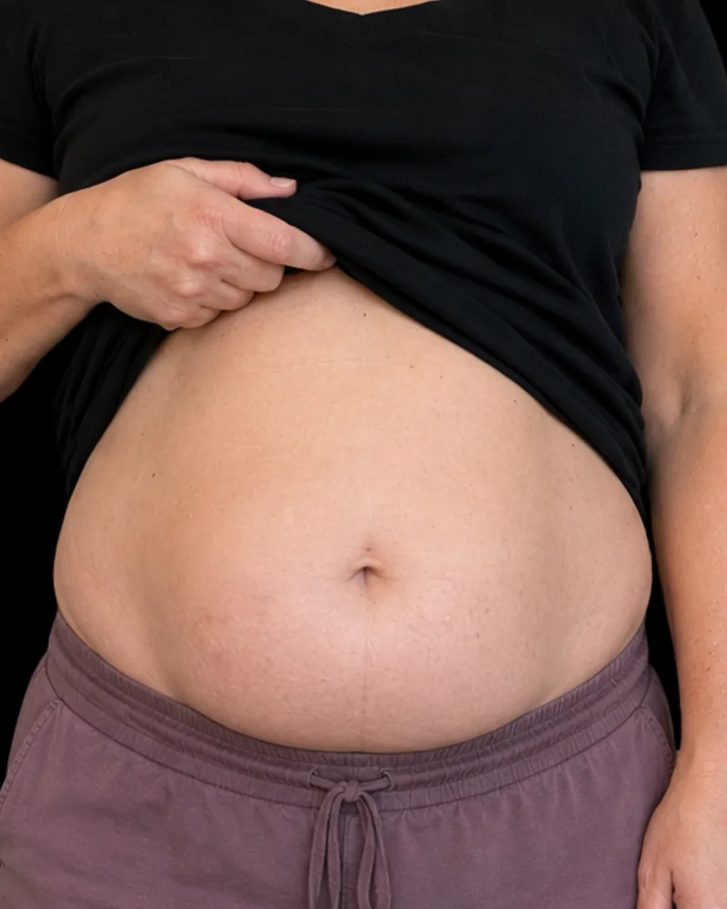 Before body sculpting, abdomen