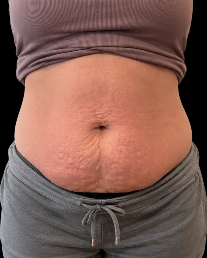 Before body sculpting, abdomen