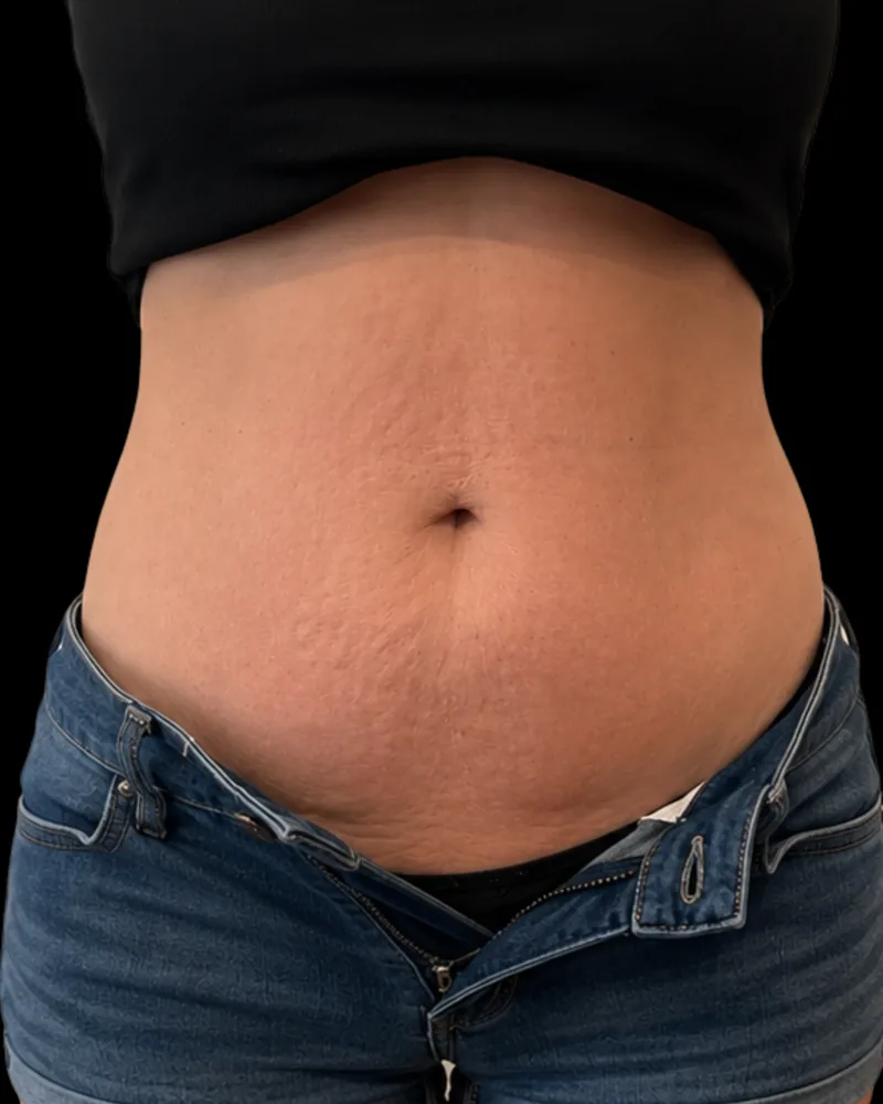 After the BAQ Method, abdomen
