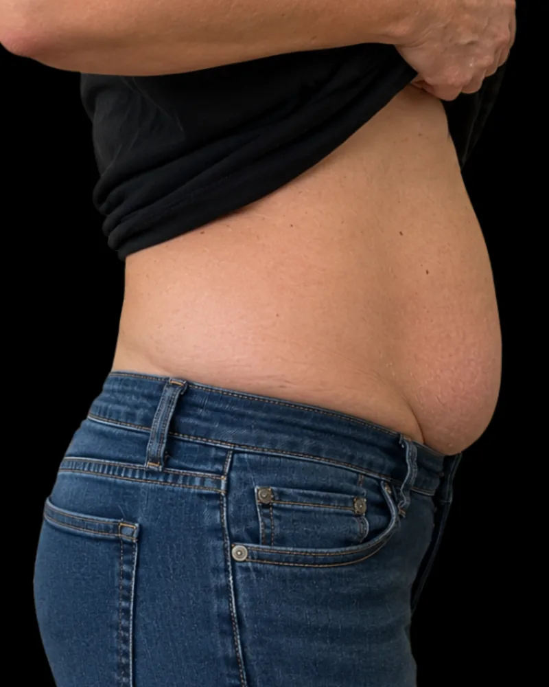 Before body sculpting, abdomen