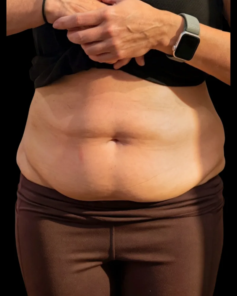 Before body sculpting, abdomen