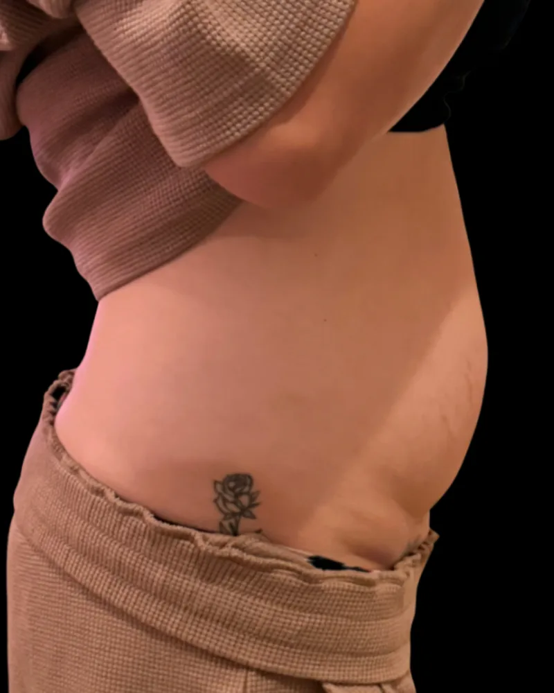 Before body sculpting, abdomen